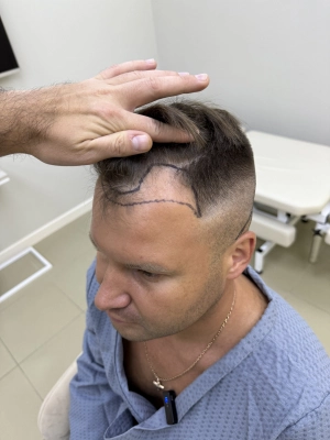 Метод FUE semi-shaving