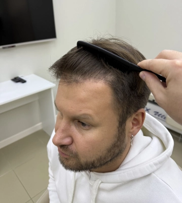 Метод FUE semi-shaving
